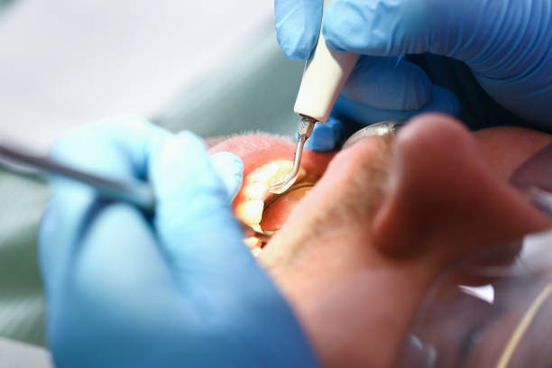 Best Emergency Tooth Extraction in Banks, OR